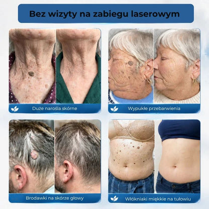 Zaawansowany wałek do usuwania brodawek skórnych i zwykłych