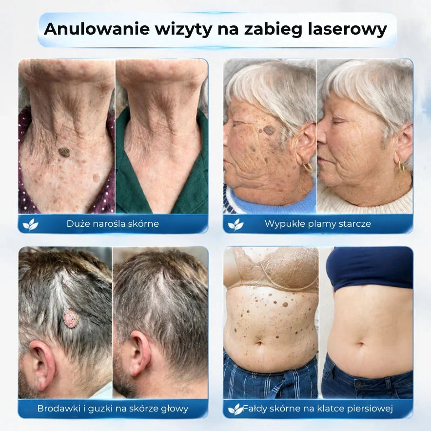Zaawansowany wałek do usuwania brodawek skórnych i zwykłych