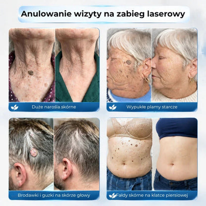 Zaawansowany wałek do usuwania brodawek skórnych i zwykłych